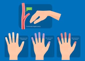 stadie kolde hænder Raynauds symptom