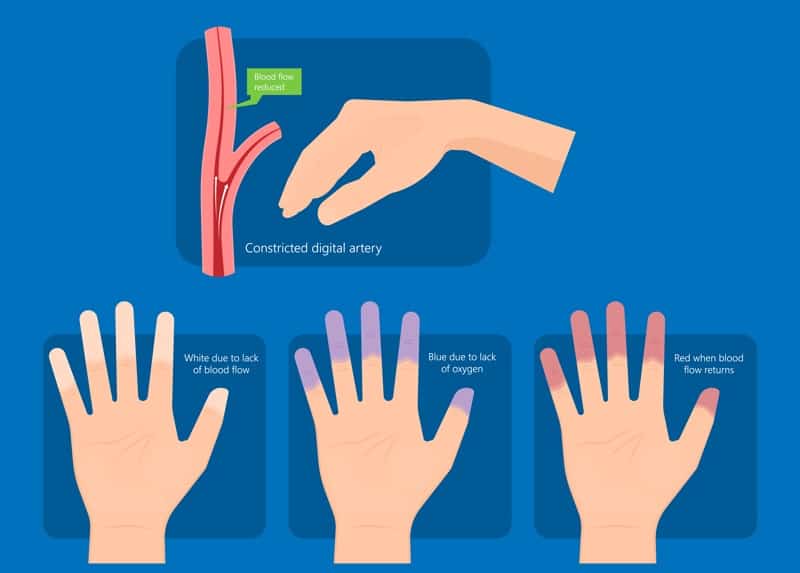 Stadien der kalten Hände Raynaud-Symptom