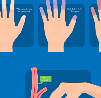 Disease of Raynaud